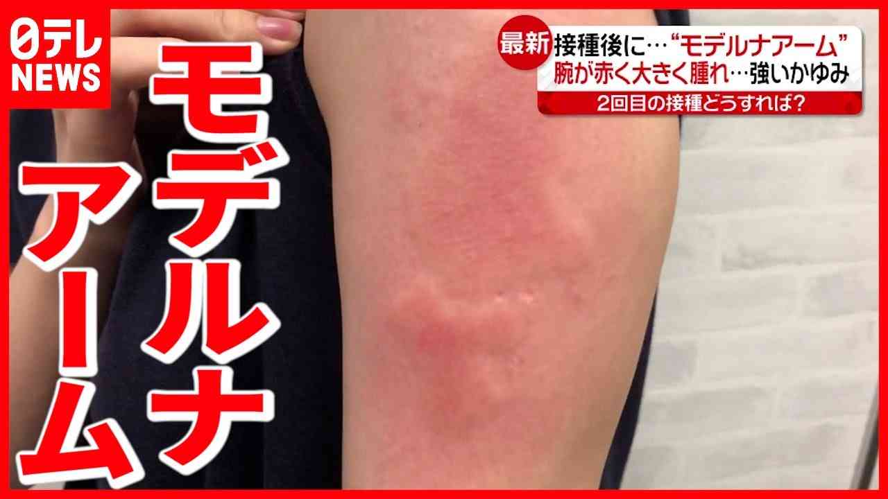 強いかゆみ＆赤い腫れ モデルナ製ワクチン接種後に多く確認（2021年7月15日放送「news every.」より） - YouTube