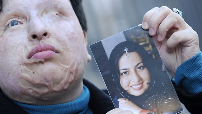 ★硫酸で失明のイラン女性、手術代と引き換えに「報復刑の免除希望」 : 知識の泉　Ｈａｒｕ’ｓ　トリビア