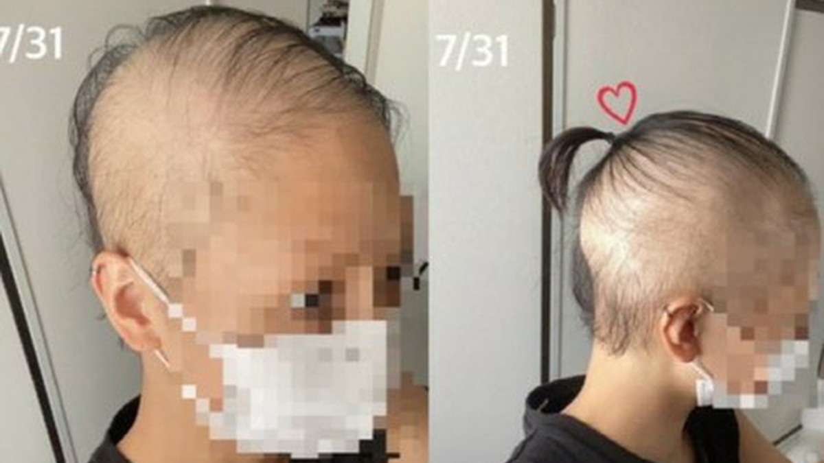 「ワクチン接種後に髪の毛が抜け落ちた…せめて医療費だけでも」＝日本人女性の訴えが韓国でも報道される│韓国社会・文化│wowKora(ワウコリア)