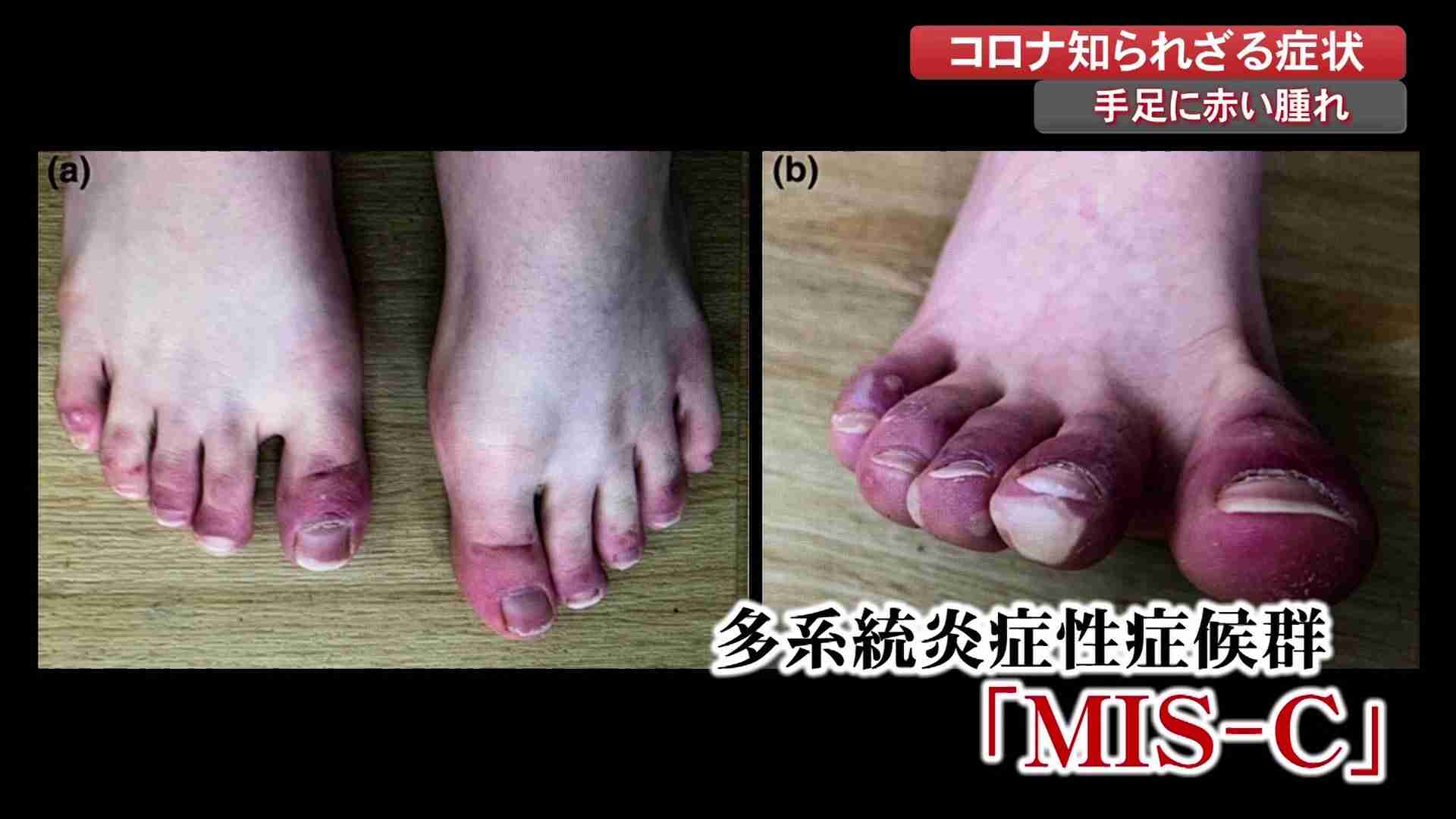 コロナ感染した子どもに