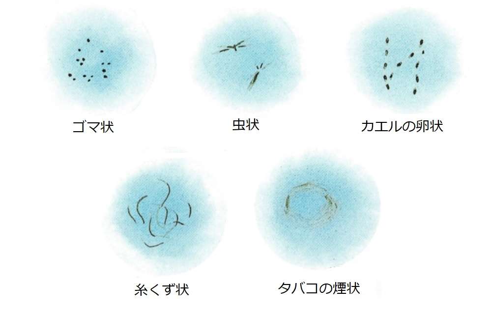 飛蚊症の人