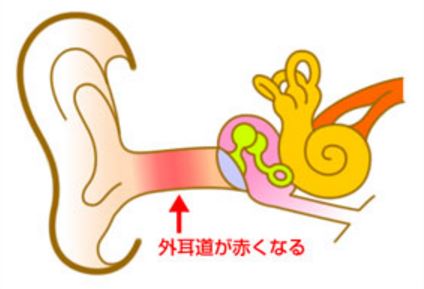 【痒い】外耳炎になったことある人【痛い】
