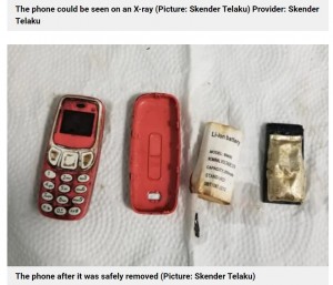 小型の携帯電話を飲み込んだ男性 医師が口から取り出す(コソボ)