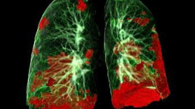 How GRAPHENE-OXIDE & EMFs Create the So Called 'COVID LUNG' (Quinta Columna)
