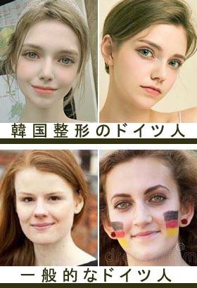 韓国整形をしたドイツ人女性 | 美容外科ヤスミクリニック