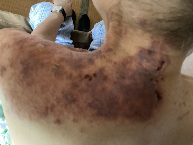 報告は氷山の一角！コロナワクチン接種後の副反応、死亡のツイートが多すぎて戦慄！vol.105 | 泣いて生まれてきたけれど