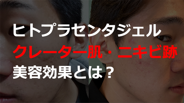 ヒトプラセンタジェルのクレーター肌・ニキビ跡への効果と使い方！素晴らしい美容効果について。 | キヨキヨの美容ブログ