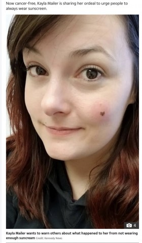 ハート型のほくろが皮膚がんだった女性「疑わしいと思ったら診察を受けて」（米）