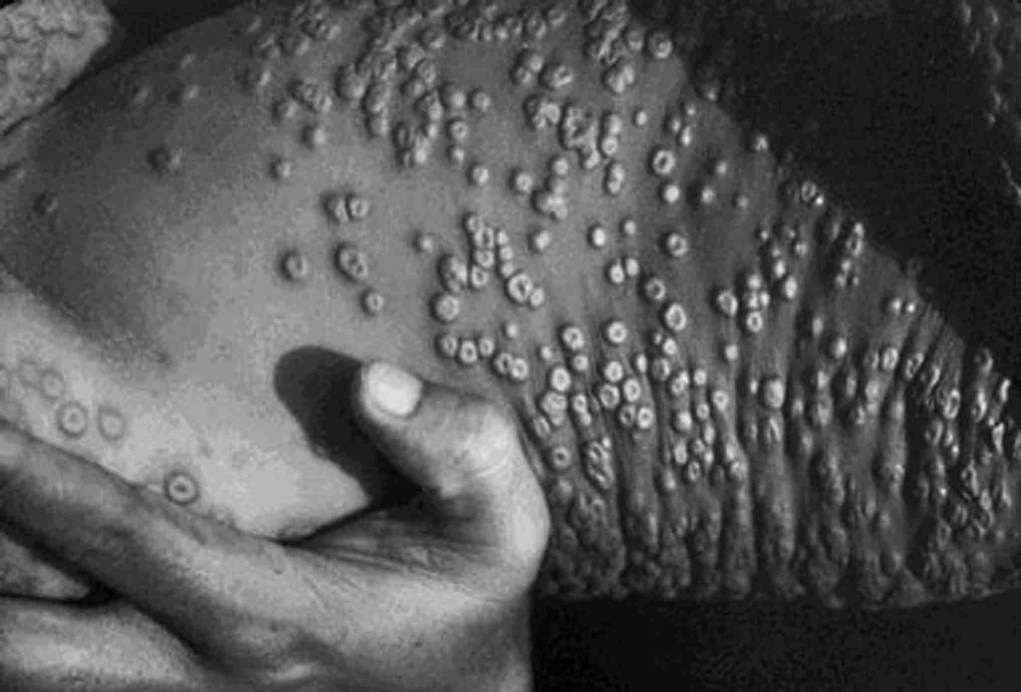 US Gov. Bought 3 Million In Smallpox Vaccines! - The True Defender !