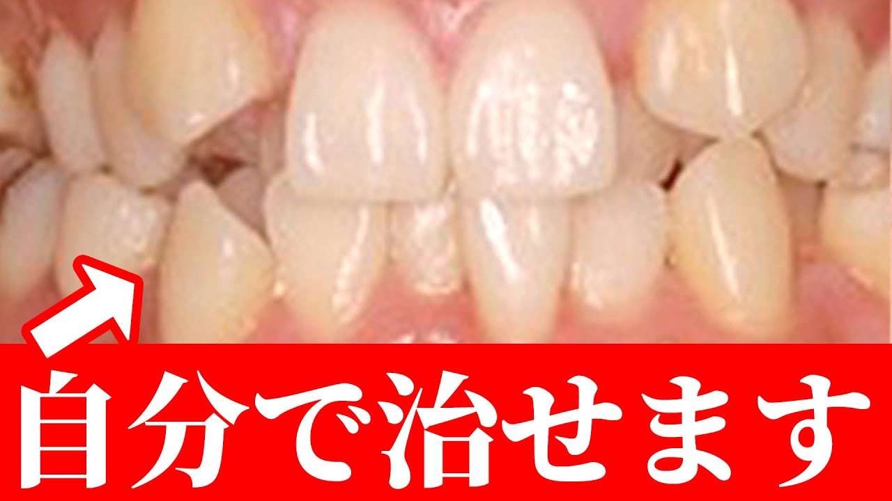 矯正せずに歯並び問題を解決する方法を歯医者が教えます！ - YouTube