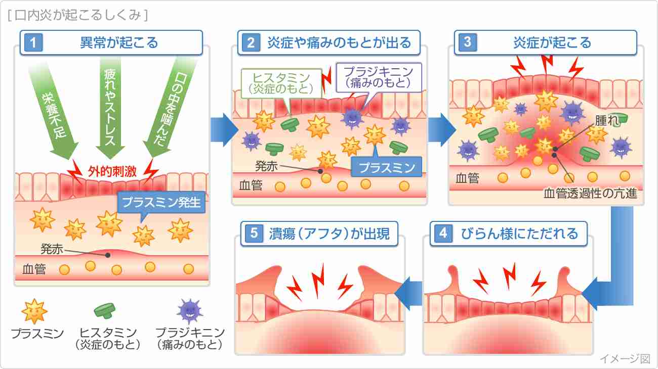 口内炎が再発しなくなった人