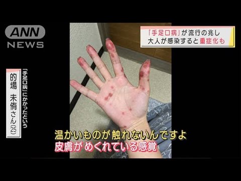 「手足口病」が流行の兆し　大人が感染すると・・・(2021年11月18日) - YouTube