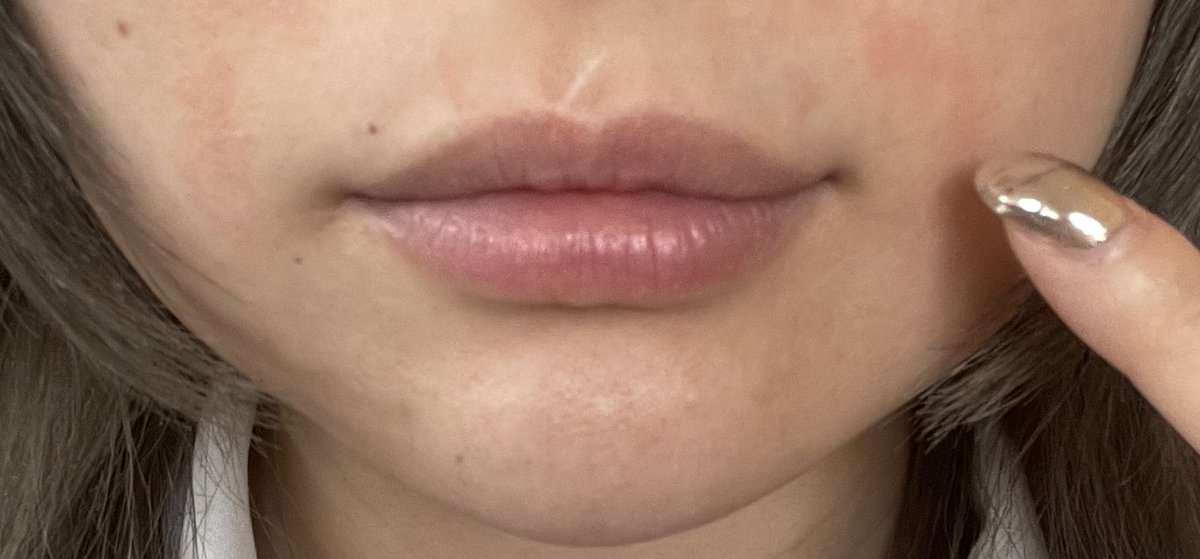 きゃりーぱみゅぱみゅ「急に肌がピリピリしてきて…」口元の写真を添え、診察可能な皮膚科の情報募る