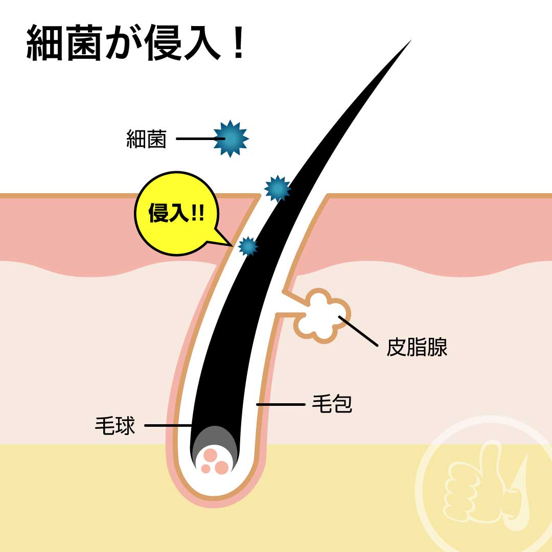 毛嚢炎(もうのうえん)が治らない