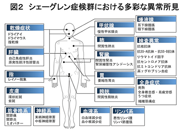 シェーグレン症候群について知りたい