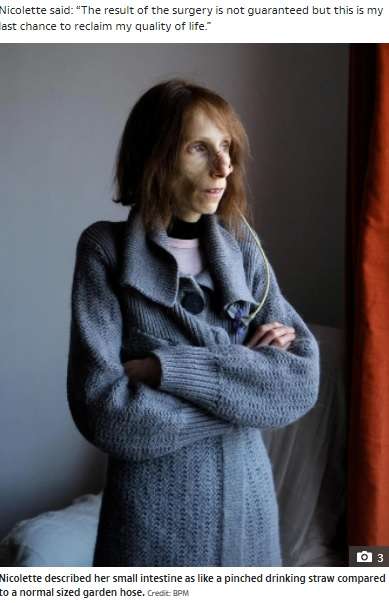 【海外発！Breaking News】体重20キロの36歳女性　稀な疾患で「このままでは死んでしまう」と手術に望みを託す（英） | Techinsight（テックインサイト）|海外セレブ、国内エンタメのオンリーワンをお届けするニュースサイト