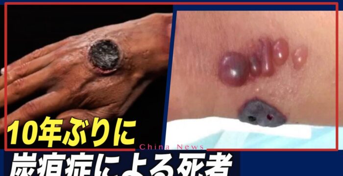 中国 10年ぶりに炭疽症による死者 | 炭疽菌 | 北京 | 感染 | NTDTV Japan