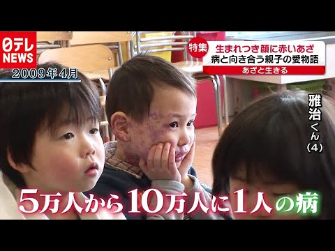 「あざと生きる少年」家族の愛と葛藤の日々（2020年10月1日放送「news every.」より） - YouTube