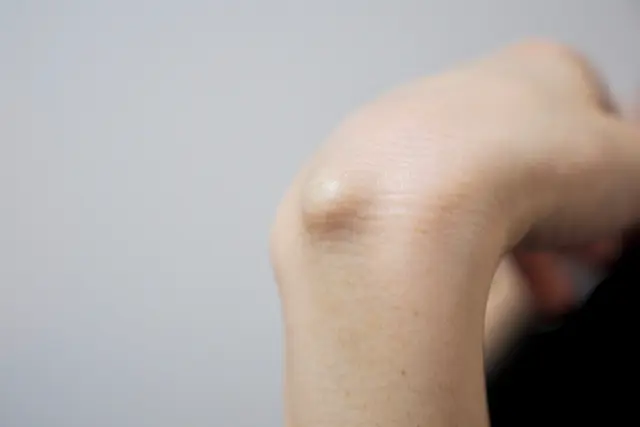 皮膚にできたコブ「粉瘤」は自然に治るのか？ 嫌な臭いがしたら要注意 | Medical DOC
