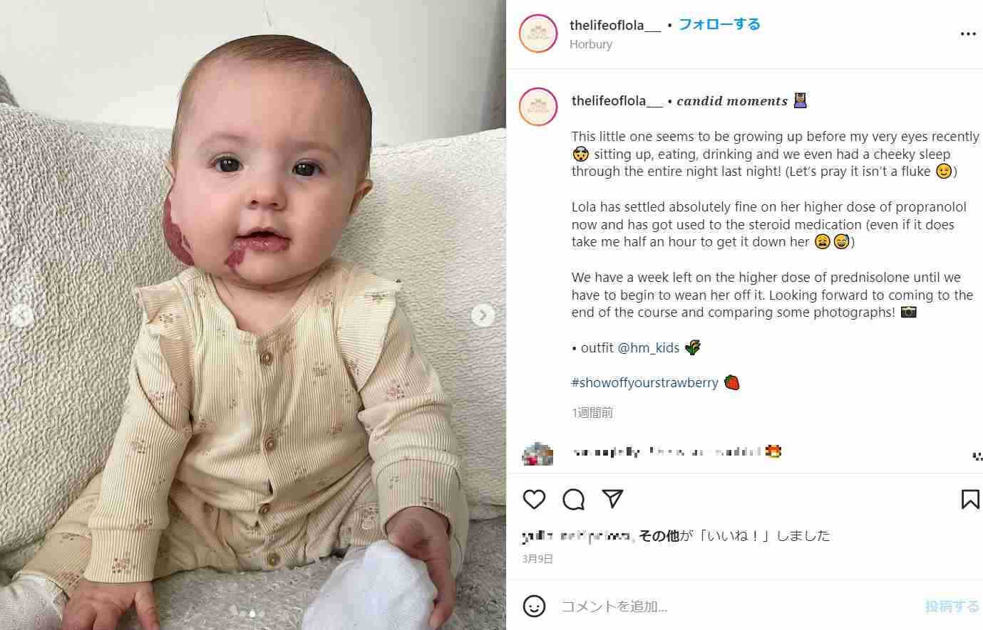 【海外発！Breaking News】生まれつき顔に赤いあざのある赤ちゃん　「虐待を疑われたことも」と母親（英） | Techinsight（テックインサイト）