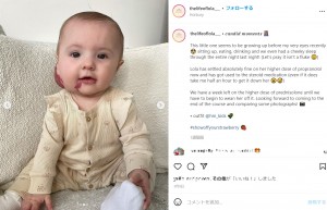 生まれつき顔に赤いあざのある赤ちゃん　「虐待を疑われたことも」と母親（英）