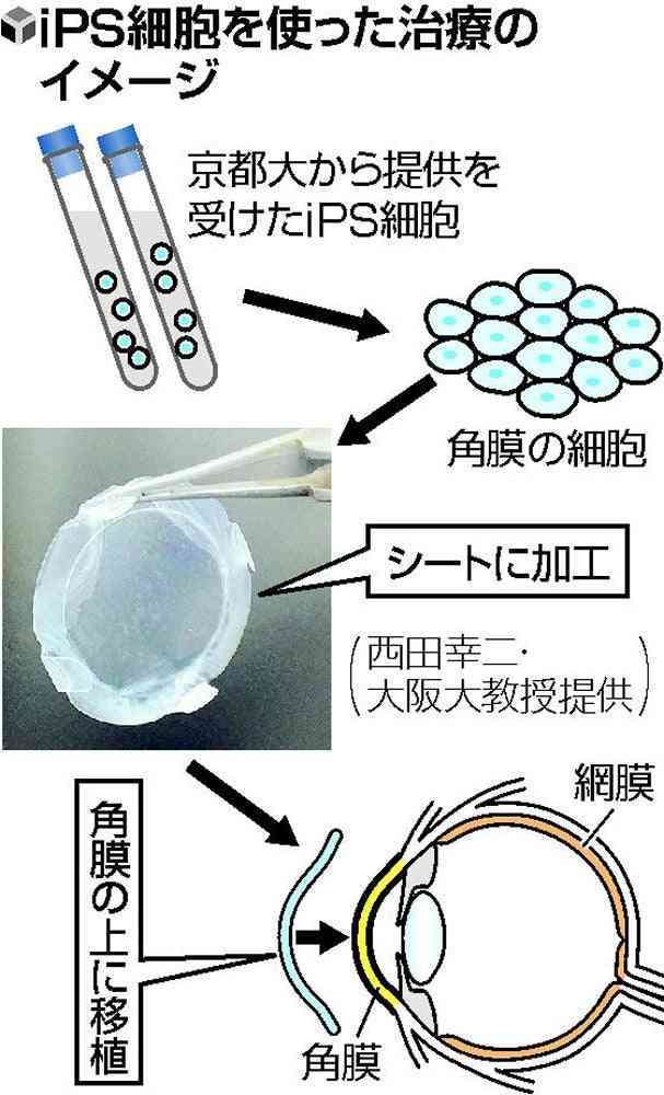 iPS細胞から作った角膜シート移植、ほぼ失明の患者が視力回復…大阪大