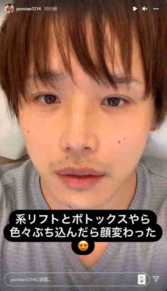 登録者数200万人超ユーチューバー・ぷろたん 整形を告白 「ちょっといじりに来た」