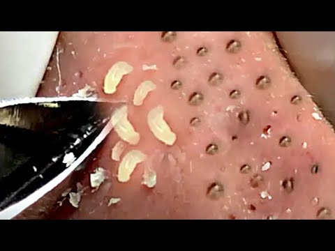 【激ゴッソリ！！】角質除去☆Blackheads⑩ - YouTube