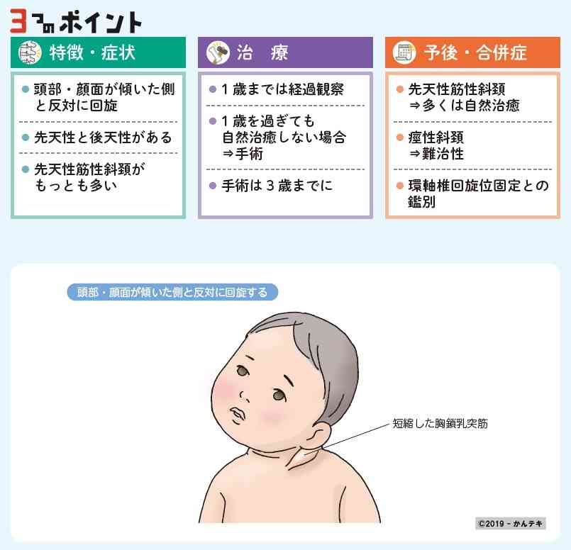 お子さんが斜頸または過去にそうだった方 ガールズちゃんねる Girls Channel