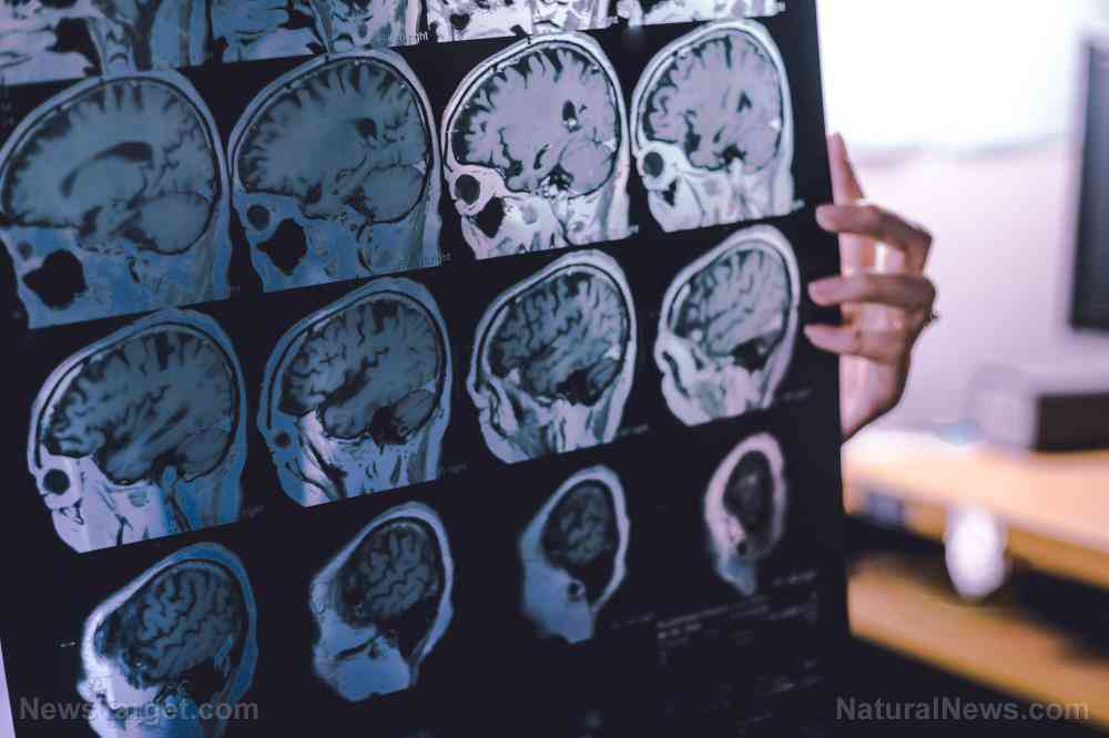 Covid-19 vaccine from Pfizer confirmed to cause brain damage, neurodegenerative disease – NaturalNews.com