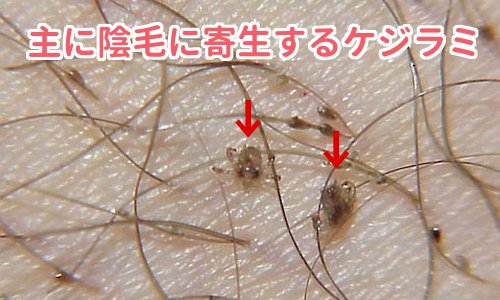 梅毒患者が急増　過去最多の21年同期比1.6倍　10年続く流行