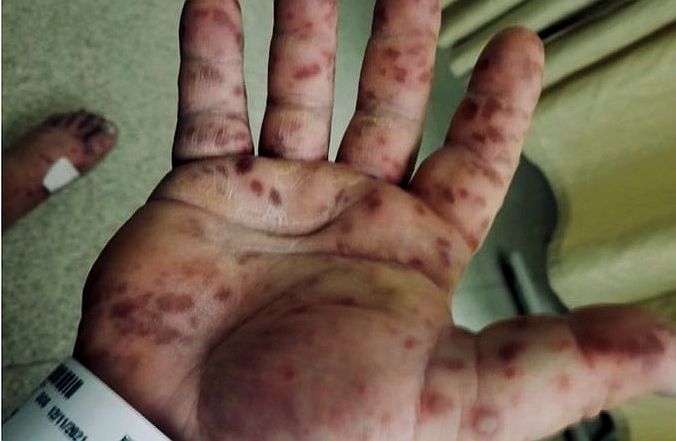 報告は氷山の一角！コロナワクチン接種後の副反応、死亡のツイートが多すぎて戦慄！vol.257 | 泣いて生まれてきたけれど