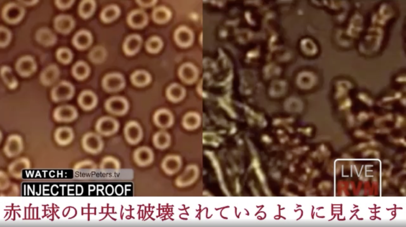 【画像・動画あり】医師らの研究により、コロナワクチンが体内の赤血球を破壊する猛毒であることが発覚!!  |  RAPT理論のさらなる進化形