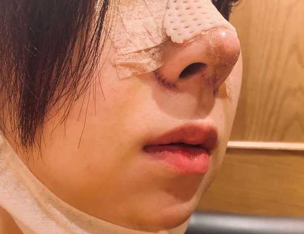“韓流整形ブーム”に沸く日本人女性   トラブルも続出！？ 年間1万人が韓国の美容外科を受診…彼女達が海を渡るワケ