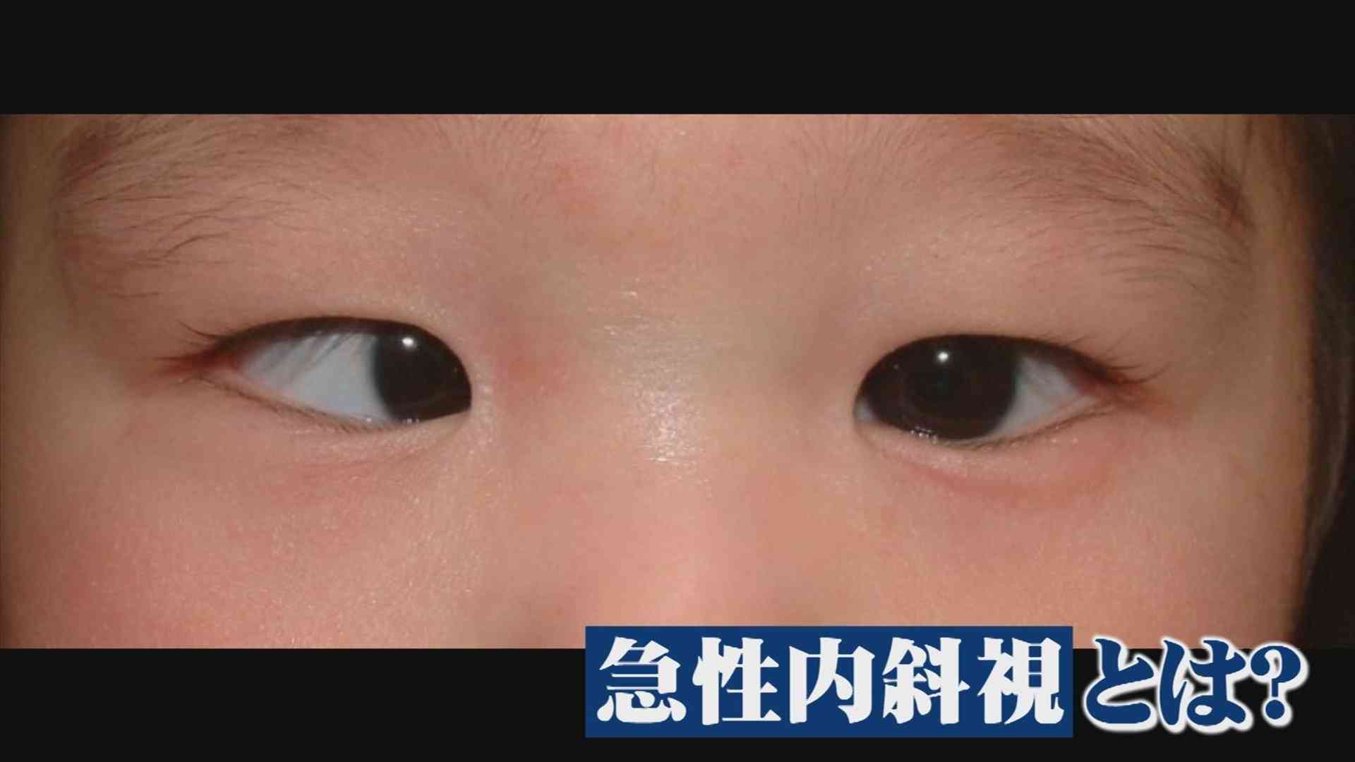 子どもや若者の「急性内斜視」が問題に　元に戻らなくなり、手術が必要となるケースも | BSSニュース | BSS山陰放送