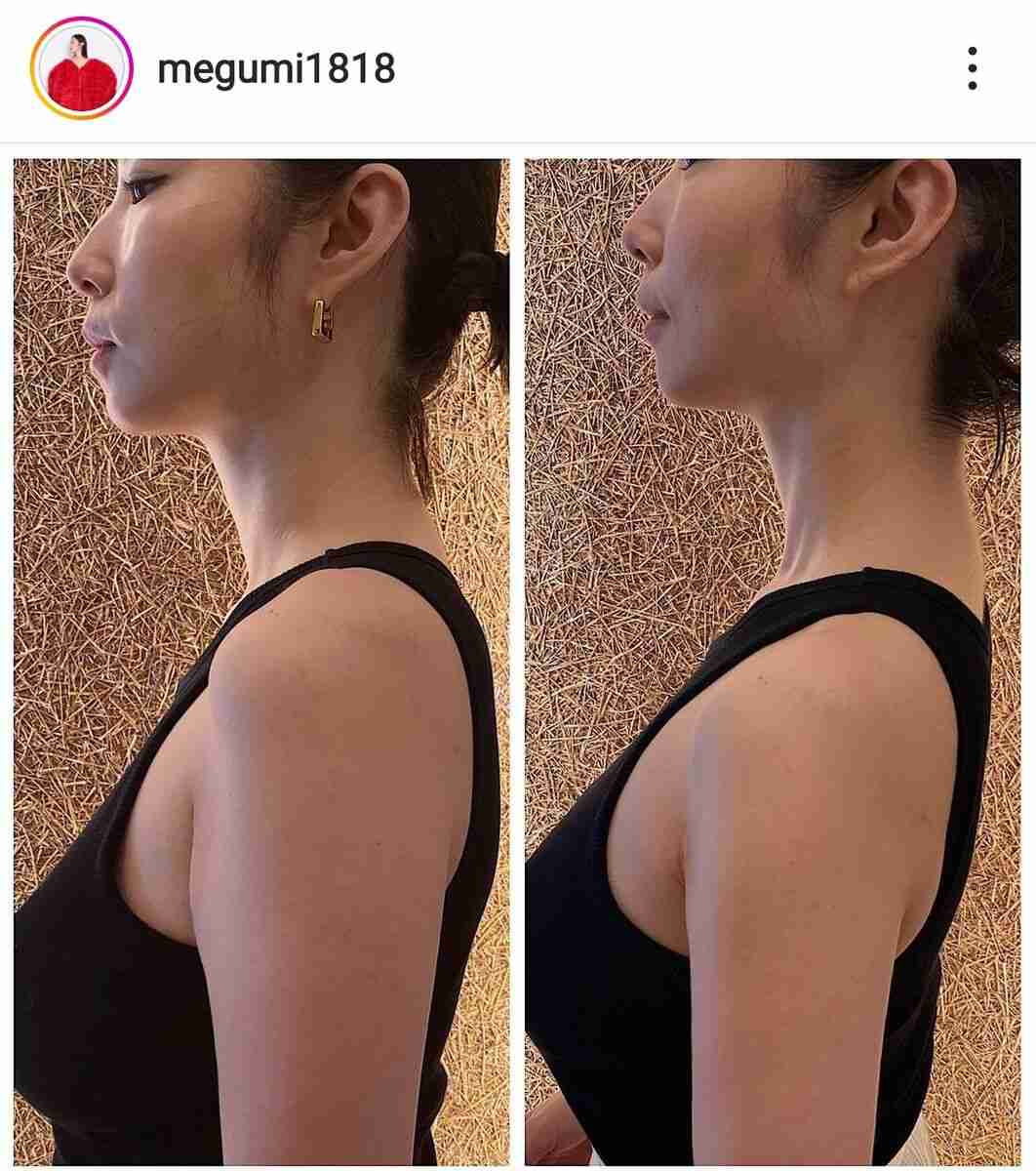 MEGUMI、美容施術のビフォーアフターを公開「さすがですね」と驚きの声も
