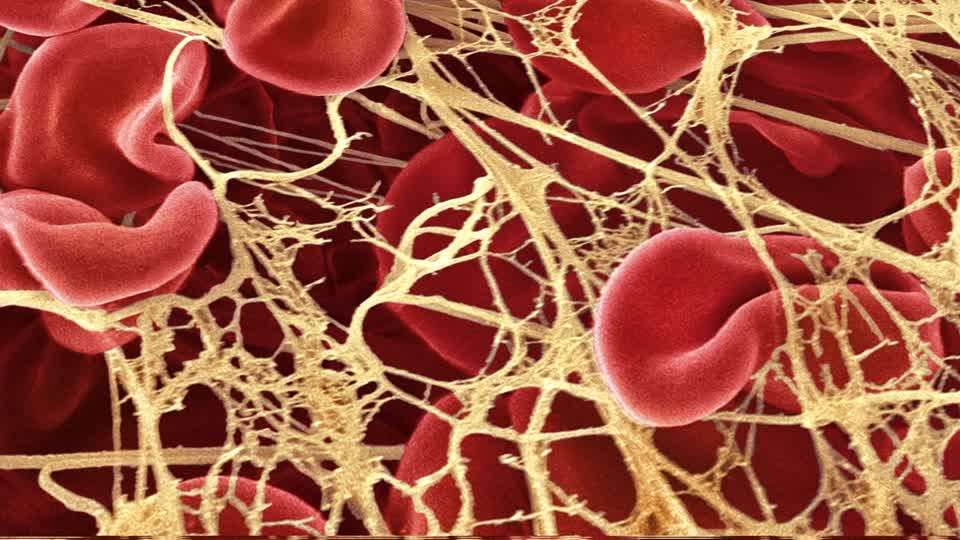 Mysterious white clots found in deceased vaccinated individuals