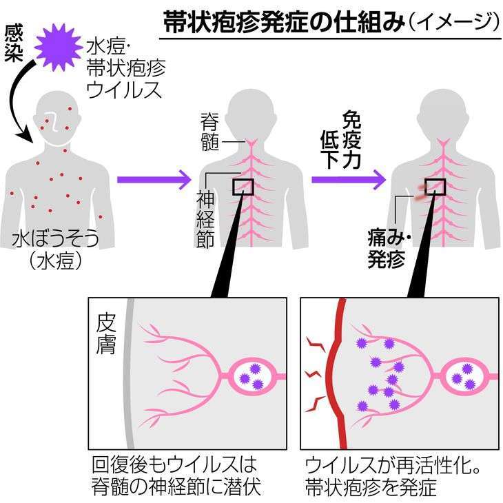 若年層にも広がる「帯状疱疹」　コロナ禍で増加に拍車か