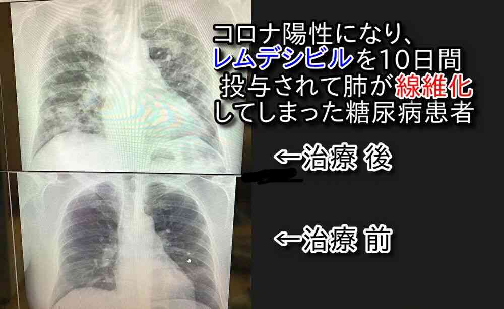 報告は氷山の一角！コロナワクチン接種後の副反応、死亡のツイートが多すぎて戦慄！vol.266 | 泣いて生まれてきたけれど
