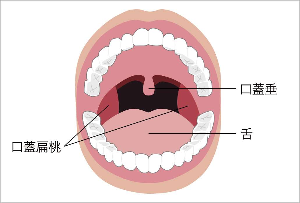 扁桃炎 (へんとうえん) | 済生会