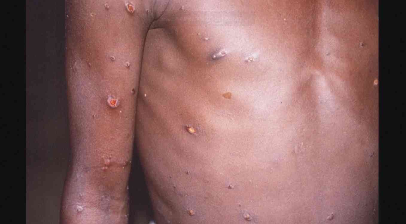 欧米中心に感染が確認されている「サル痘」　特徴や予防法を医師に聞いた（FNNプライムオンライン） - Yahoo!ニュース