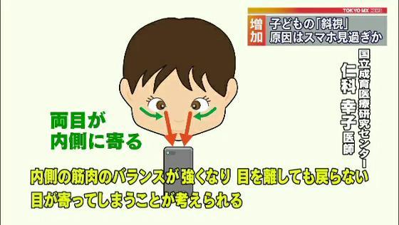 子どもや若者の「急性内斜視」が問題に　元に戻らなくなり、手術が必要となるケースも