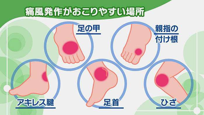 痛風になったことある人