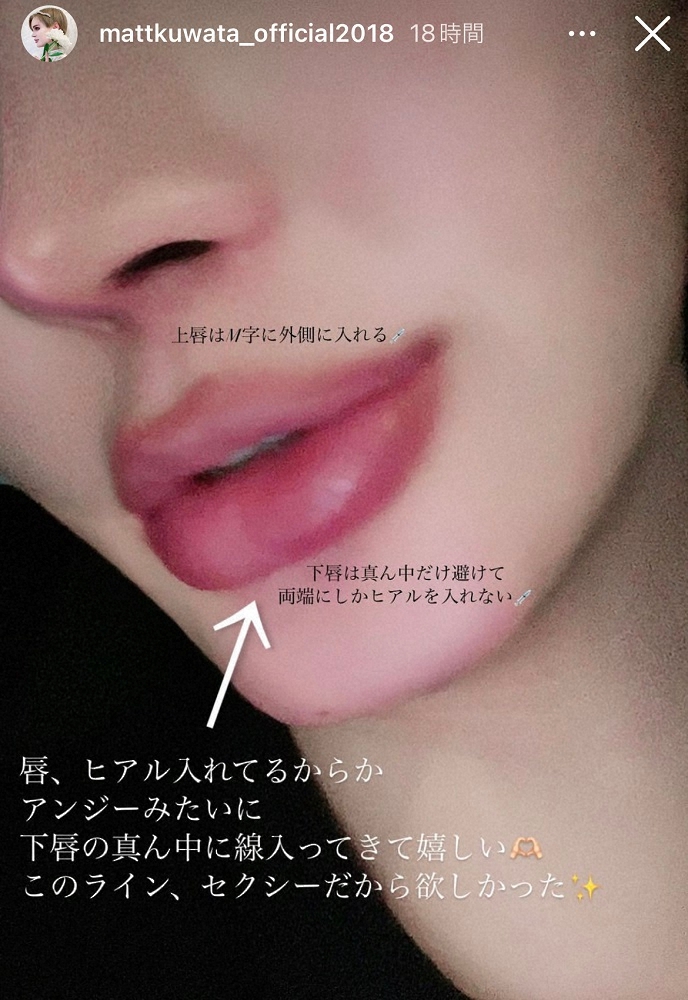 Matt、ヒアルロン酸入れた唇のドアップ公開「アンジーみたいに線入って嬉しい」　ネットは「凄い」― スポニチ Sponichi Annex 芸能