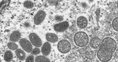 サル痘、欧州の危険性「高い」に　50カ国に感染拡大 ｜ 共同通信