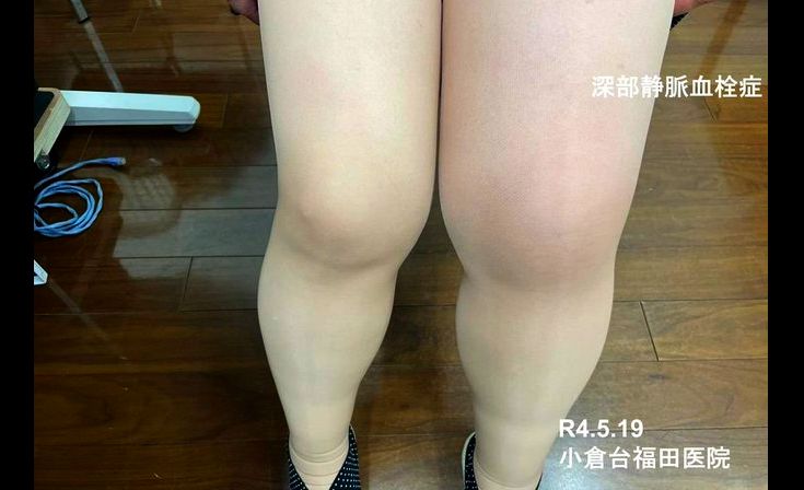 報告は氷山の一角！コロナワクチン接種後の副反応、死亡のツイートが多すぎて戦慄！vol.296 | 泣いて生まれてきたけれど