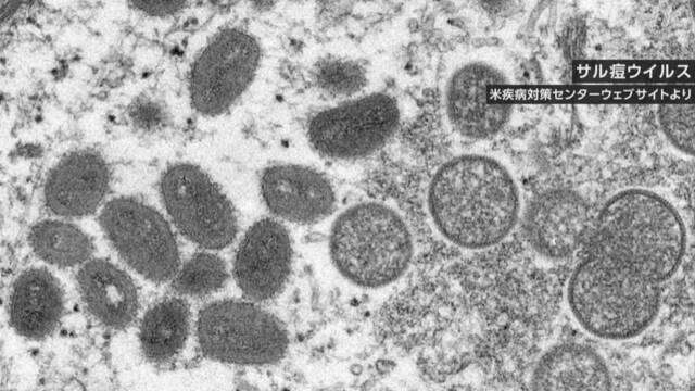 サル痘に備え 天然痘治療薬 研究目的で投与可能に 厚労省 | NHK | サル痘