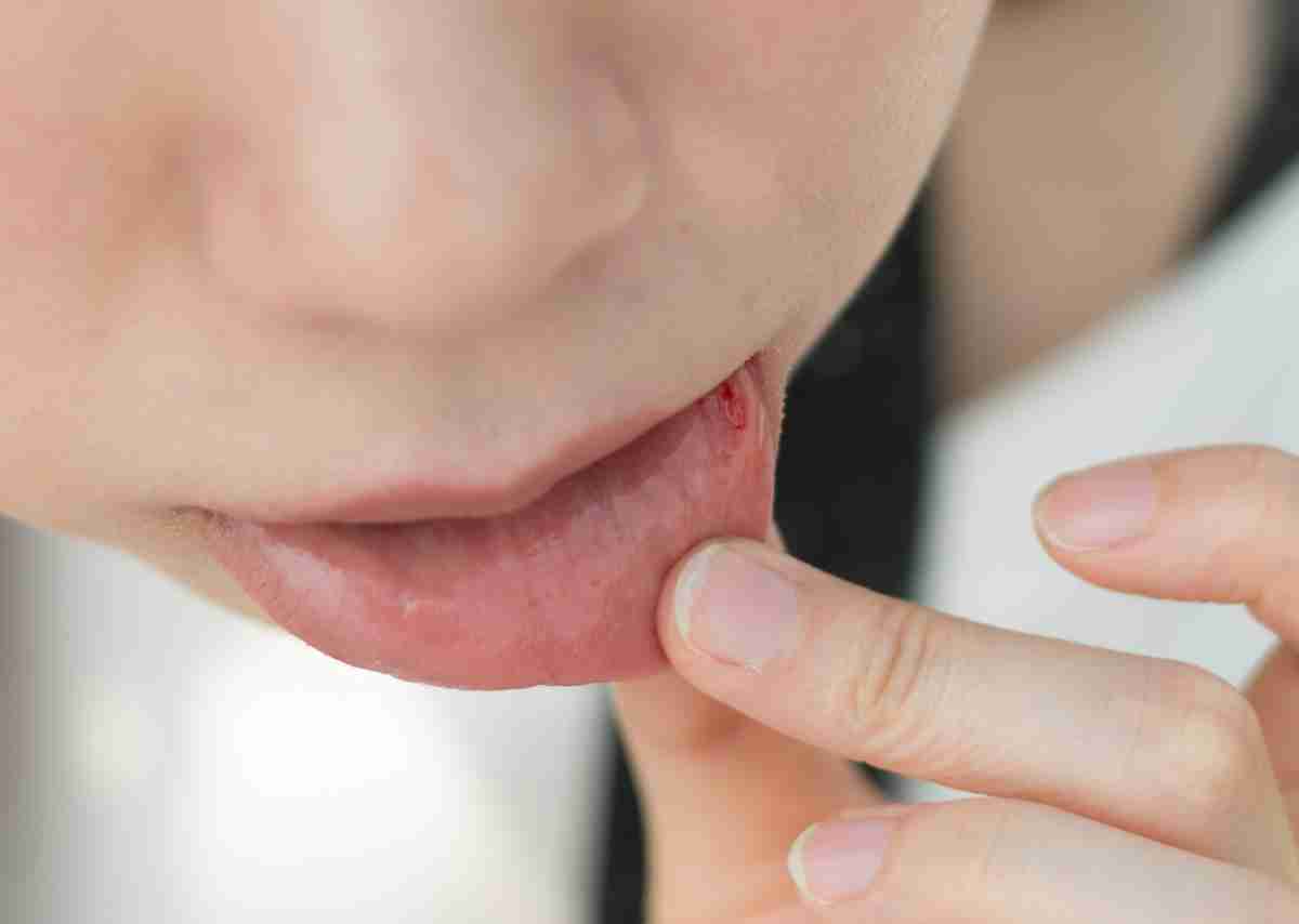 舌に「血豆」状のもの、放置してもいい？ 重病の可能性は？ 専門家に聞く | オトナンサー