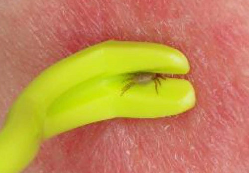血で満腹になるまでは、ライターであぶっても離れない! 最終手段は「皮膚ごと切除」…マダニ<対策実践編>