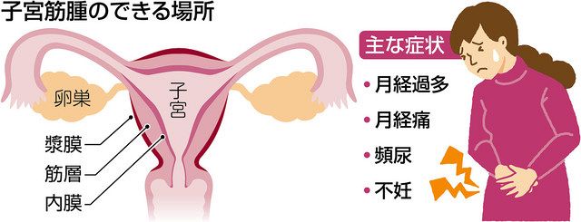 子宮筋腫持ちの人で話そう